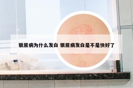銀屑病為什么發(fā)白 銀屑病發(fā)白是不是快好了