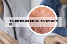 貴陽治療銀屑病哪里比較好 貴陽銀屑病研究院