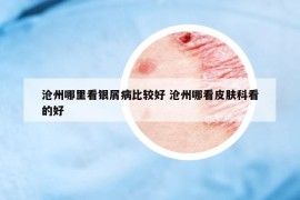 滄州哪里看銀屑病比較好 滄州哪看皮膚科看的好