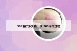 308治療多少錢一次 308治療過程