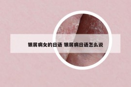 銀屑病女的日語 銀屑病日語怎么說