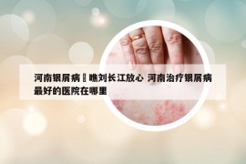 河南銀屑病來瞧劉長江放心 河南治療銀屑病最好的醫(yī)院在哪里
