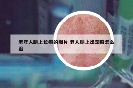 老年人腿上長癬的圖片 老人腿上出現(xiàn)癬怎么治