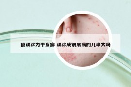 被誤診為牛皮癬 誤診成銀屑病的幾率大嗎