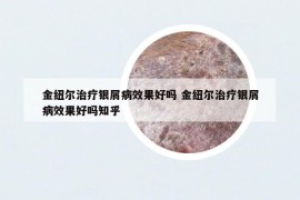 金紐爾治療銀屑病效果好嗎 金紐爾治療銀屑病效果好嗎知乎
