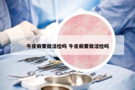 牛皮癬要做活檢嗎 牛皮癬要做活檢嗎