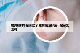 銀屑病四年后自愈了 銀屑病治好后一定會復發(fā)嗎