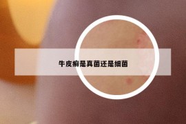 牛皮癬是真菌還是細(xì)菌