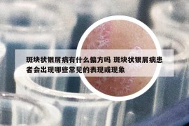 斑塊狀銀屑病有什么偏方嗎 斑塊狀銀屑病患者會出現(xiàn)哪些常見的表現(xiàn)或現(xiàn)象