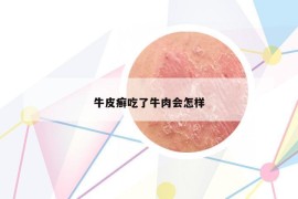 牛皮癬吃了牛肉會怎樣