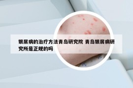 銀屑病的治療方法青島研究院 青島銀屑病研究所是正規(guī)的嗎