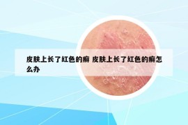 皮膚上長了紅色的癬 皮膚上長了紅色的癬怎么辦