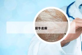 尿牛皮癬