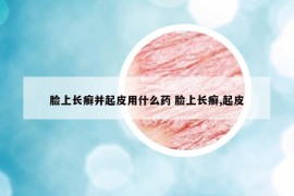 臉上長(zhǎng)癬并起皮用什么藥 臉上長(zhǎng)癬,起皮