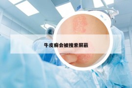 牛皮癬會被搜索屏蔽