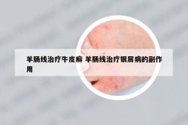 羊腸線治療牛皮癬 羊腸線治療銀屑病的副作用