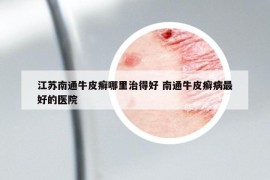 江蘇南通牛皮癬哪里治得好 南通牛皮癬病最好的醫(yī)院