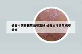長春中醫(yī)看銀屑病哪家好 長春治療銀屑病哪里好
