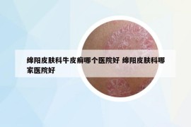 綿陽皮膚科牛皮癬哪個(gè)醫(yī)院好 綿陽皮膚科哪家醫(yī)院好