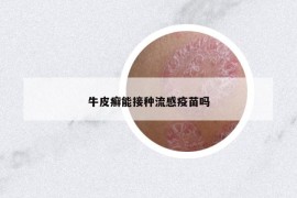 牛皮癬能接種流感疫苗嗎