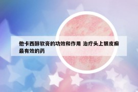 他卡西醇軟膏的功效和作用 治療頭上銀皮癬最有效的藥