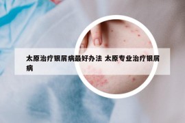 太原治療銀屑病最好辦法 太原專(zhuān)業(yè)治療銀屑病