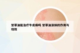 甘草油能治療牛皮癬嗎 甘草油涂抹的作用與功效