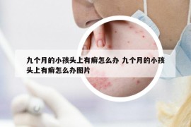 九個(gè)月的小孩頭上有癬怎么辦 九個(gè)月的小孩頭上有癬怎么辦圖片