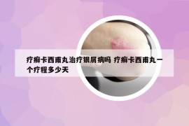療癬卡西甫丸治療銀屑病嗎 療癬卡西甫丸一個(gè)療程多少天