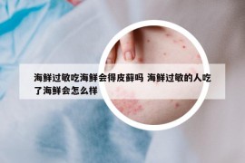 海鮮過敏吃海鮮會(huì)得皮蘚嗎 海鮮過敏的人吃了海鮮會(huì)怎么樣
