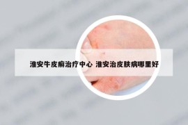 淮安牛皮癬治療中心 淮安治皮膚病哪里好
