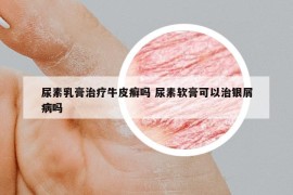 尿素乳膏治療牛皮癬嗎 尿素軟膏可以治銀屑病嗎