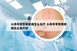 小孩尋常型銀屑病怎么治療 小孩尋常型銀屑病怎么治療好
