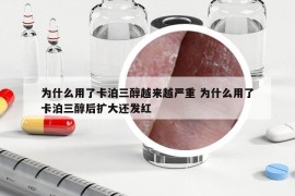 為什么用了卡泊三醇越來(lái)越嚴(yán)重 為什么用了卡泊三醇后擴(kuò)大還發(fā)紅