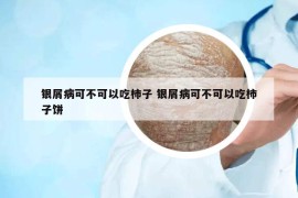 銀屑病可不可以吃柿子 銀屑病可不可以吃柿子餅