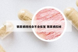 銀屑病埋線會(huì)不會(huì)反復(fù) 銀屑病扣掉