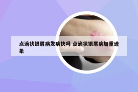 點(diǎn)滴狀銀屑病發(fā)病快嗎 點(diǎn)滴狀銀屑病加重跡象