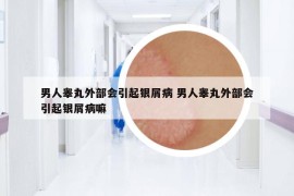 男人睪丸外部會(huì)引起銀屑病 男人睪丸外部會(huì)引起銀屑病嘛