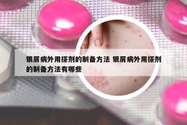 銀屑病外用搽劑的制備方法 銀屑病外用搽劑的制備方法有哪些