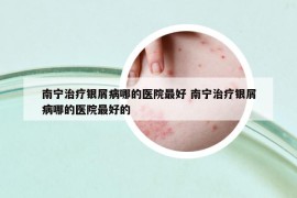 南寧治療銀屑病哪的醫(yī)院最好 南寧治療銀屑病哪的醫(yī)院最好的