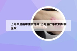 上海牛皮癬哪里有郎中 上海治療牛皮病癬的醫(yī)院