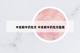 中皮癬中藥處方 中皮癬中藥處方醫(yī)案