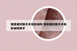 銀屑病對做手術(shù)有影響嗎 銀屑病對做手術(shù)有影響嗎知乎
