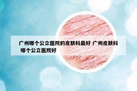 廣州哪個(gè)公立醫(yī)院的皮膚科最好 廣州皮膚科 哪個(gè)公立醫(yī)院好