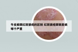 牛皮癬跟紅斑狼瘡的區(qū)別 紅斑狼瘡跟銀屑病哪個嚴重