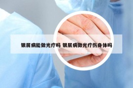 銀屑病能做光療嗎 銀屑病做光療傷身體嗎