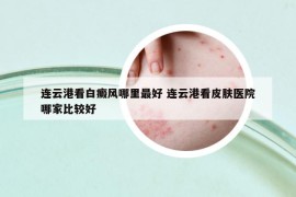 連云港看白癜風(fēng)哪里最好 連云港看皮膚醫(yī)院哪家比較好