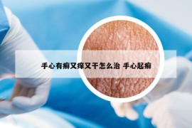 手心有癬又癢又干怎么治 手心起癬