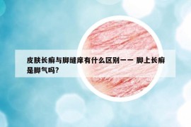 皮膚長(zhǎng)癬與腳縫庠有什么區(qū)別一一 腳上長(zhǎng)癬是腳氣嗎?