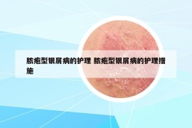 膿皰型銀屑病的護(hù)理 膿皰型銀屑病的護(hù)理措施